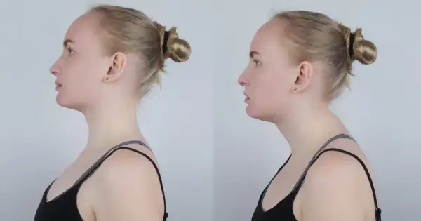 Dwie fotografie profilowe kobiety: po lewej z prostą postawą, po prawej z widocznym **wdowim garbem** i zaokrąglonymi plecami.