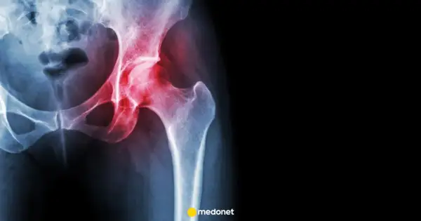 RTG miednicy z zaznaczonym bólem biodra, wskazującym na objaw Trendelenburga.