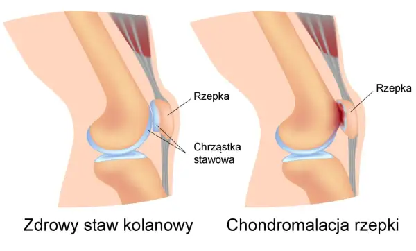 Porównanie zdrowego stawu kolanowego z zaawansowaną chondropatią 3 stopnia kolana, gdzie chrząstka jest mocno uszkodzona.