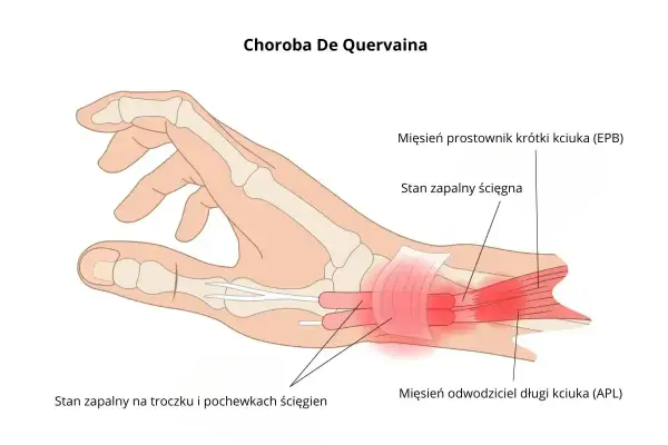 Anatomia dłoni z zaznaczonym zapaleniem ścięgien kciuka (choroba De Quervaina). Dowiedz się, ile trwa nadwyrężenie nadgarstka.