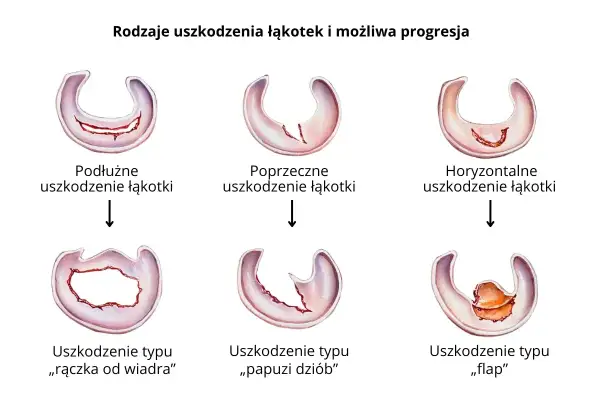 Ilustracja pokazuje różne rodzaje uszkodzeń łąkotki bocznej: podłużne, poprzeczne, horyzontalne, typu "rączka od wiadra", "papuzi dziób" i "flap".