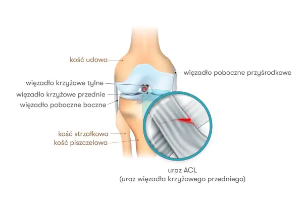 Anatomia kolana z zaznaczonym urazem ACL. Widoczne kości udowa, piszczelowa, strzałkowa oraz więzadła. Powiększenie ukazuje zerwane więzadło krzyżowe przednie.