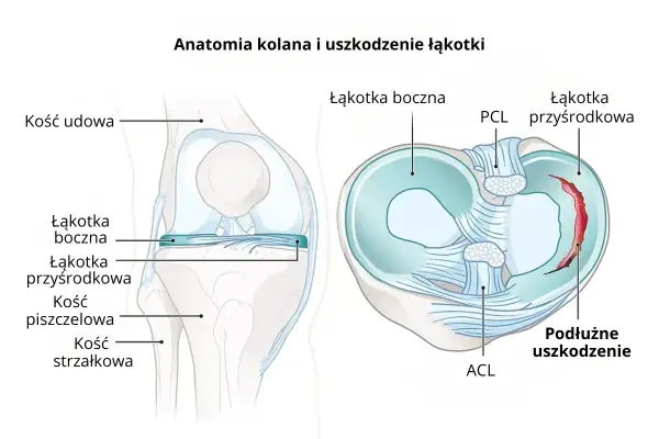 Anatomia kolana z widocznym podłużnym uszkodzeniem łąkotki przyśrodkowej.