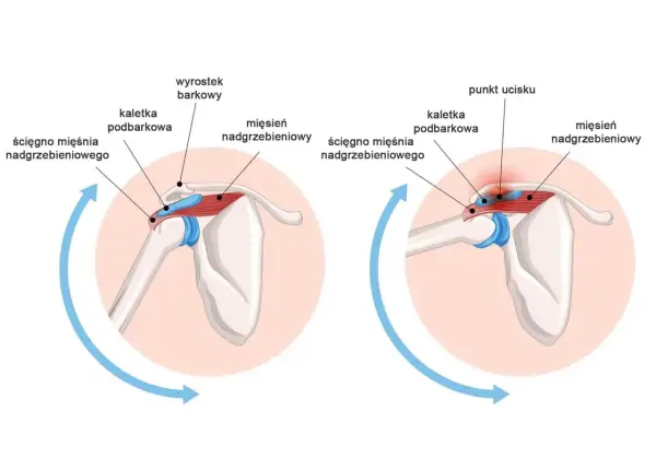 Anatomia barku: mięsień nadgrzebieniowy, ścięgno mięśnia nadgrzebieniowego i kaletka podbarkowa. Po prawej widać punkt ucisku.