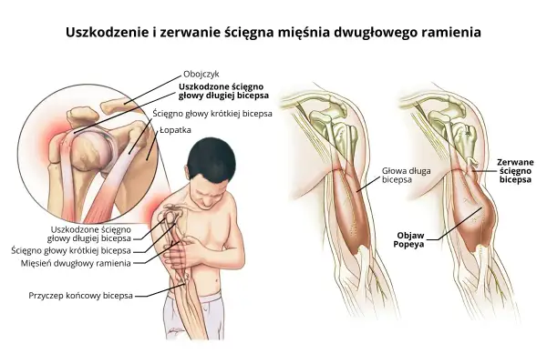 Ilustracja pokazuje uszkodzenie i zerwanie ścięgna mięśnia dwugłowego ramienia (bicepsa), w tym objaw Popeya.
