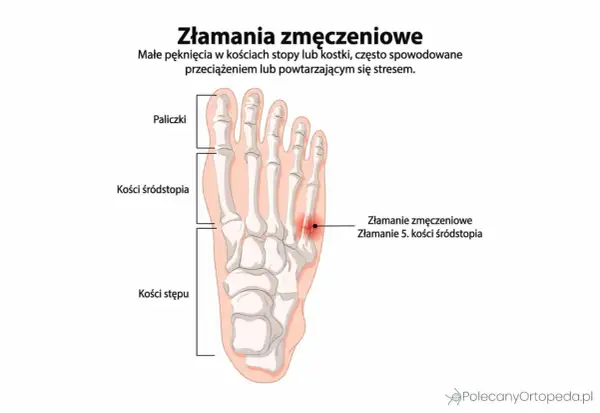 Złamanie zmęczeniowe 5. kości śródstopia, widoczne na schemacie stopy, to małe pęknięcie spowodowane przeciążeniem.