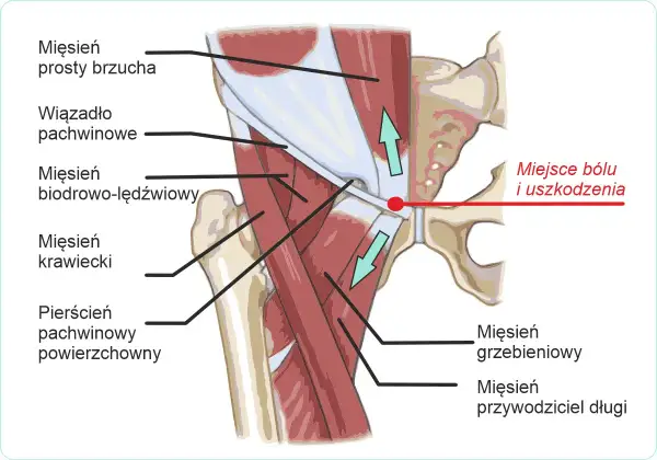 Anatomia pachwiny z zaznaczonym miejscem bólu. Widoczny mięsień grzebieniowy, przywodziciel długi, biodrowo-lędźwiowy, krawiecki, prosty brzucha, wiązadło pachwinowe i pierścień pachwinowy.